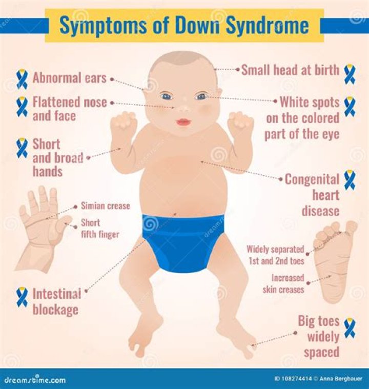 Down Syndrom Symptoms stock vector. Illustration of indication 108274414
