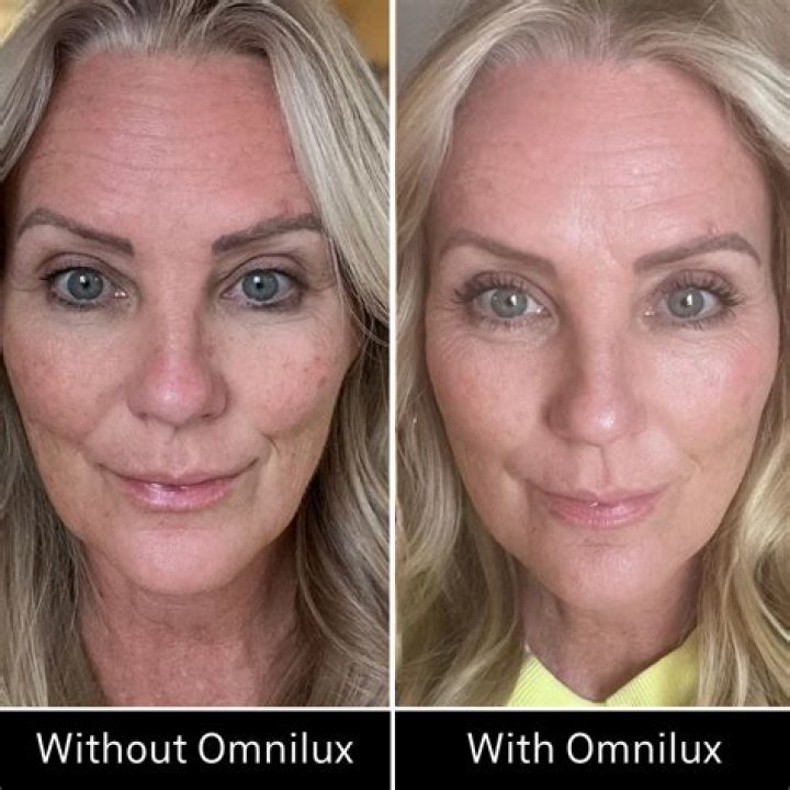 Omnilux contour before and after