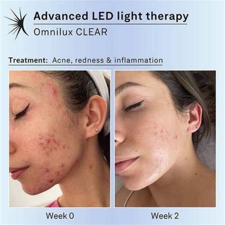 Omnilux LED Mask before and aftrer